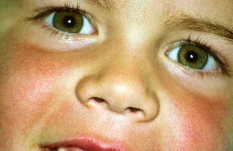 Le lupus érythémateux disséminé Caratello Le lupus érythémateux disséminé Caratello